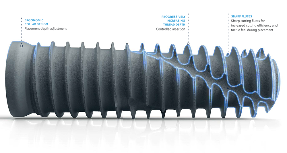 Close-up view of the ZimVie T3 PRO dental implant highlighting its ergonomic collar design for placement depth adjustment, progressively increasing thread depth for controlled insertion, and sharp flutes designed to improve cutting efficiency and tactile feedback during placement.
