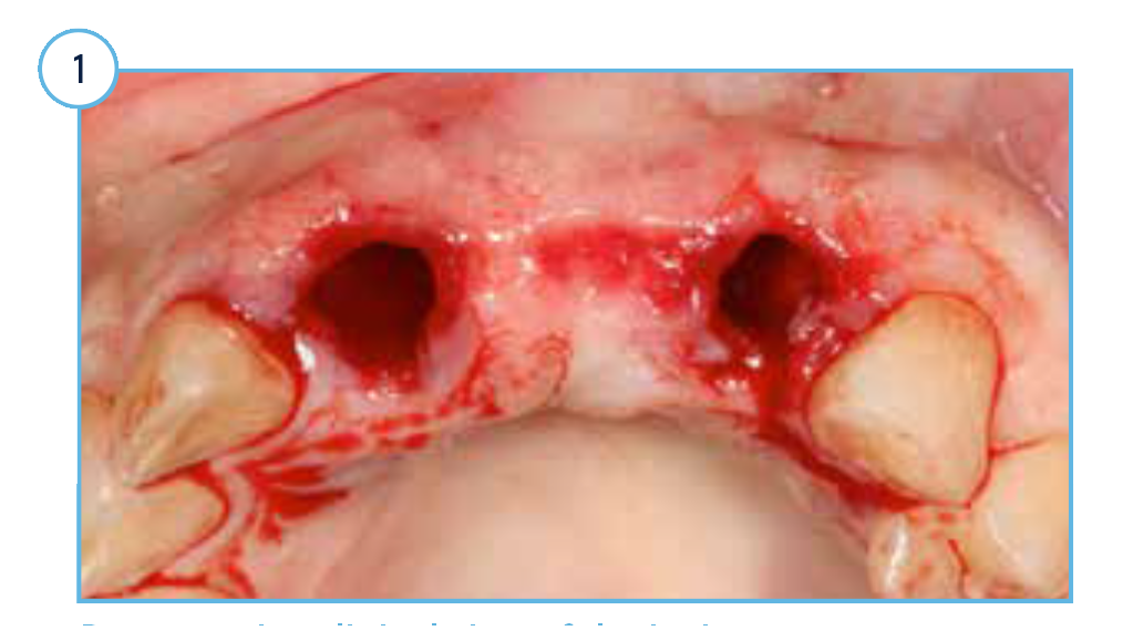 Preoperative clinical view of the incisor extraction sockets.
