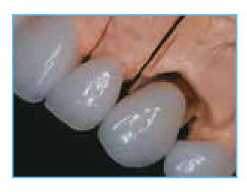 An image of the final crowns for both the natural teeth and the implant, as they appear on the master cast before being cemented in the patient's mouth.