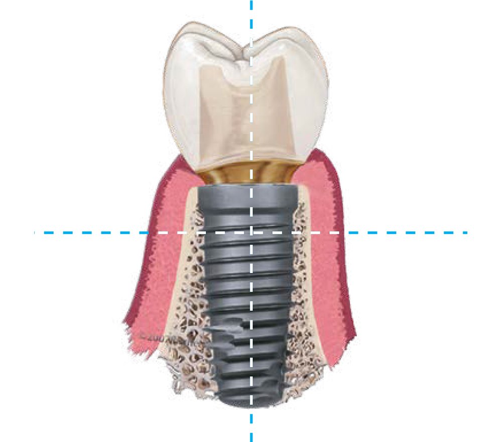 ZimVie Dental Navigator Implant System For Guided Surgery Cross Section View