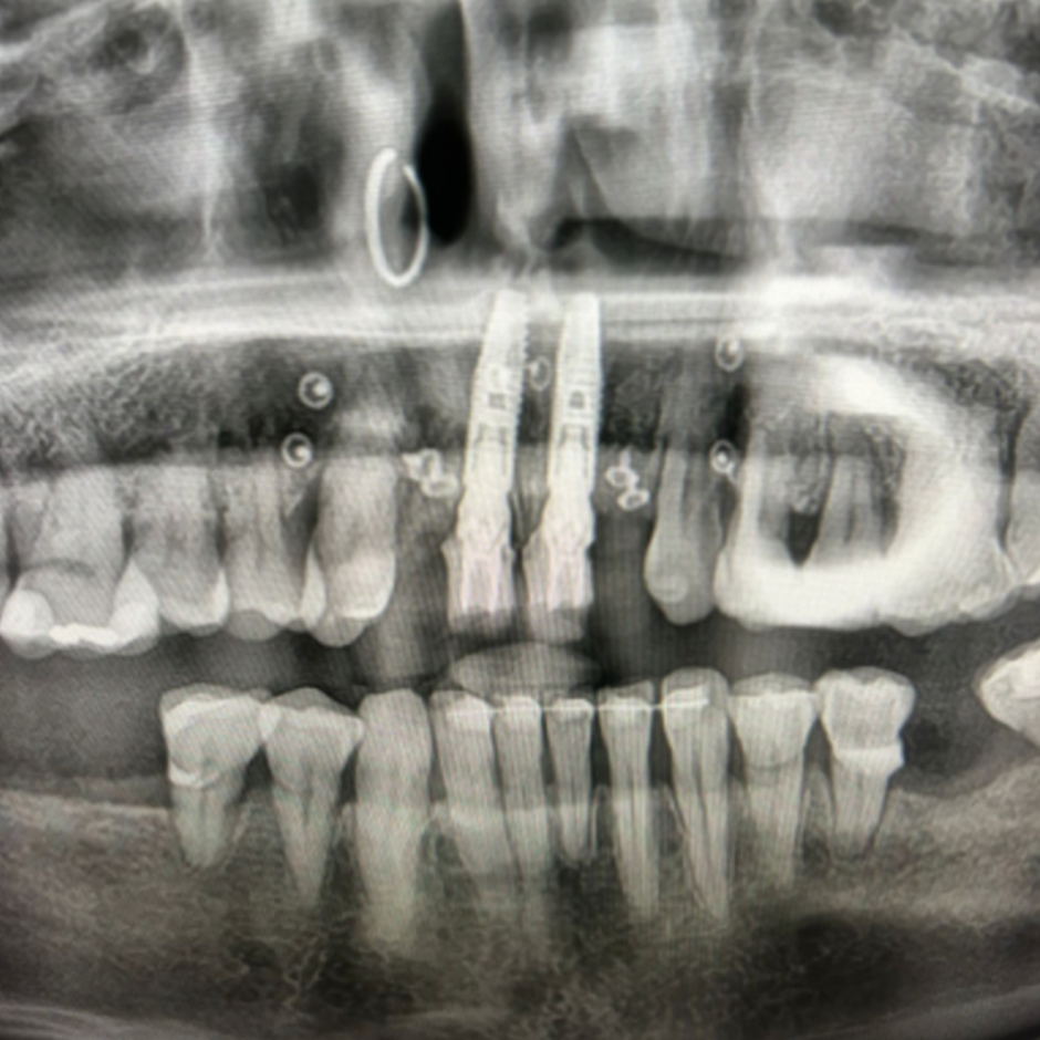 Clinical Case 1: 2 Implants Bridge in aesthetic zone immediately loaded​. Image 1