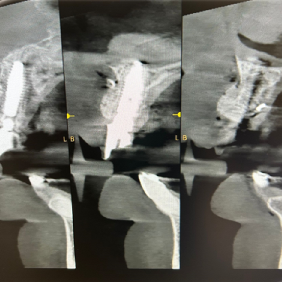 Clinical Case 1: 2 Implants Bridge in aesthetic zone immediately loaded​. Image 2