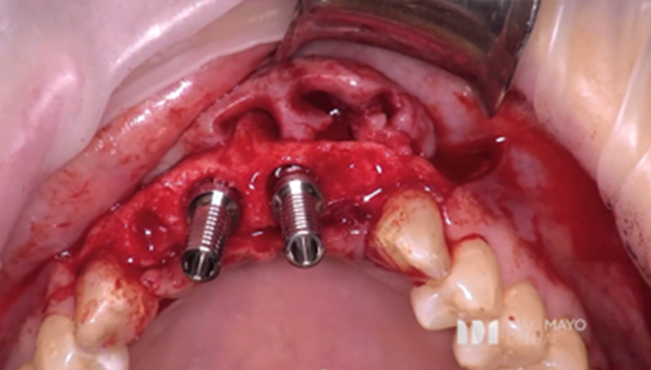 Clinical Case 1: 2 Implants Bridge in aesthetic zone immediately loaded​. Image 7