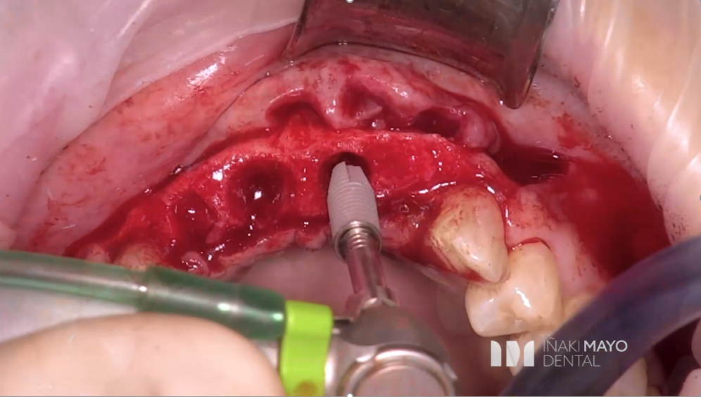 Clinical Case 1: 2 Implants Bridge in aesthetic zone immediately loaded​. Image 4