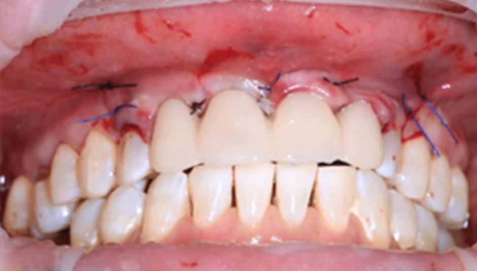 Clinical Case 1: 2 Implants Bridge in aesthetic zone immediately loaded​ - Image 9