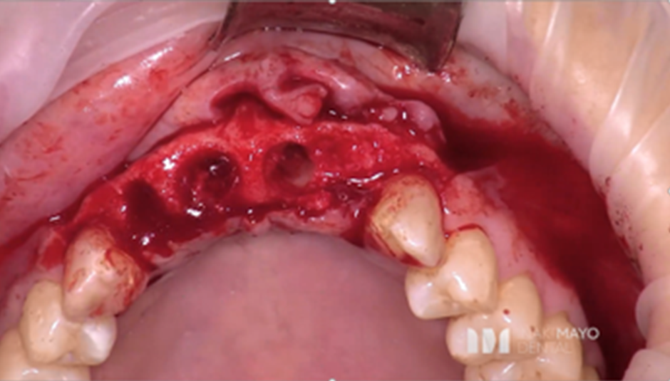 Clinical Case 1: 2 Implants Bridge in aesthetic zone immediately loaded​. Image 3