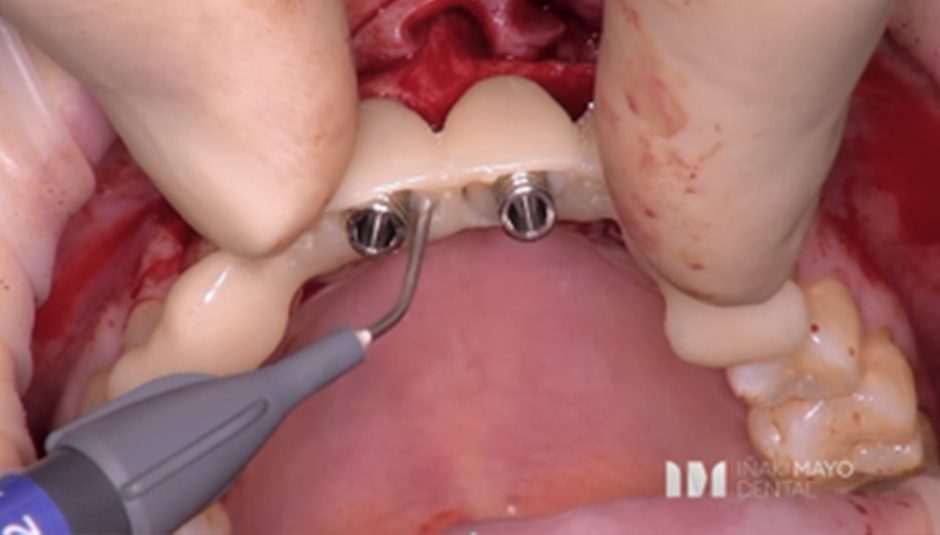 Clinical Case 1: 2 Implants Bridge in aesthetic zone immediately loaded​. Image 8