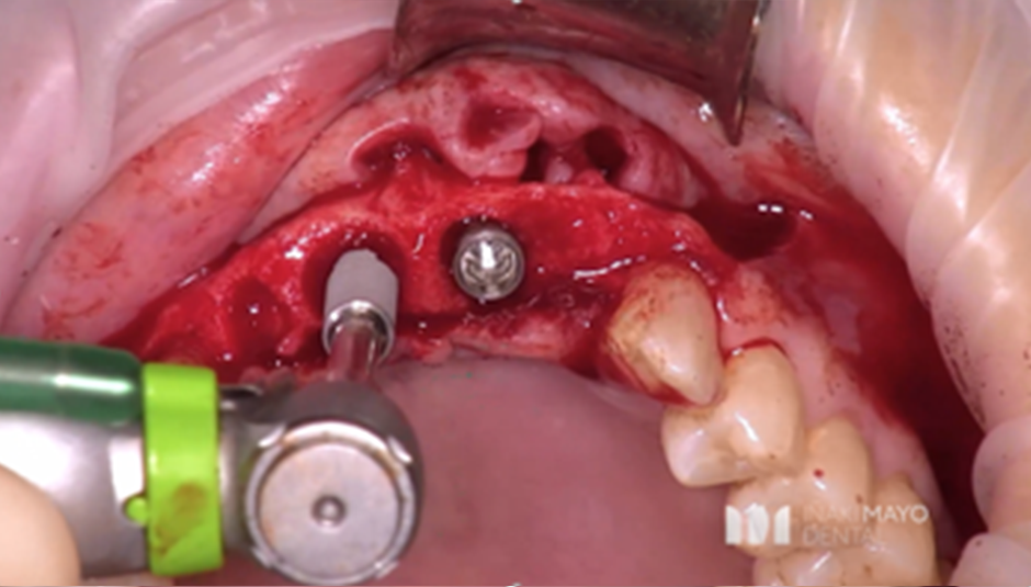 Clinical Case 1: 2 Implants Bridge in aesthetic zone immediately loaded​. Image 5