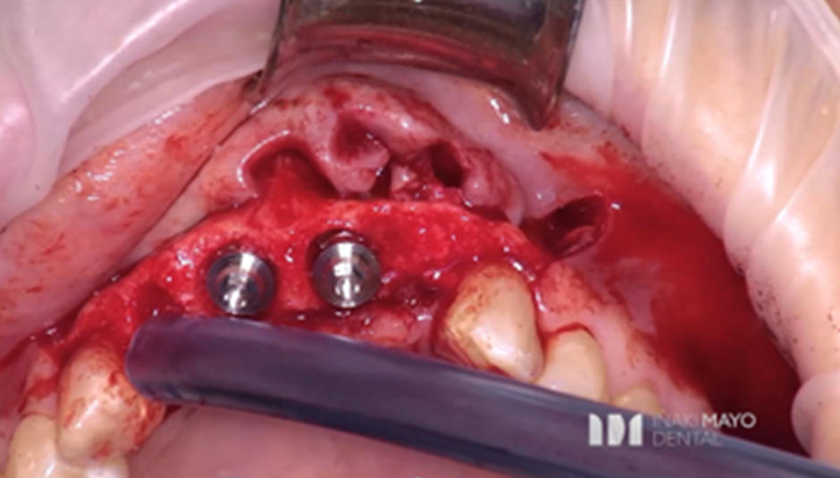 Clinical Case 1: 2 Implants Bridge in aesthetic zone immediately loaded​. Image 6