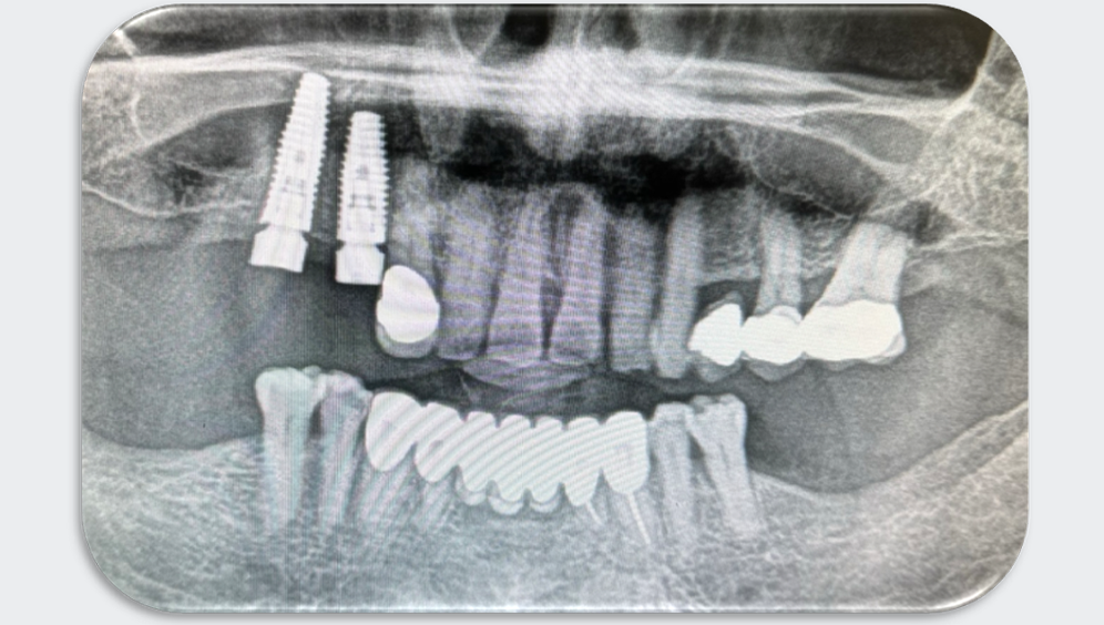 Azure Clinical Case 3 Bridge with 2 posterior Implants (14 and 16) – Part I. Image 2