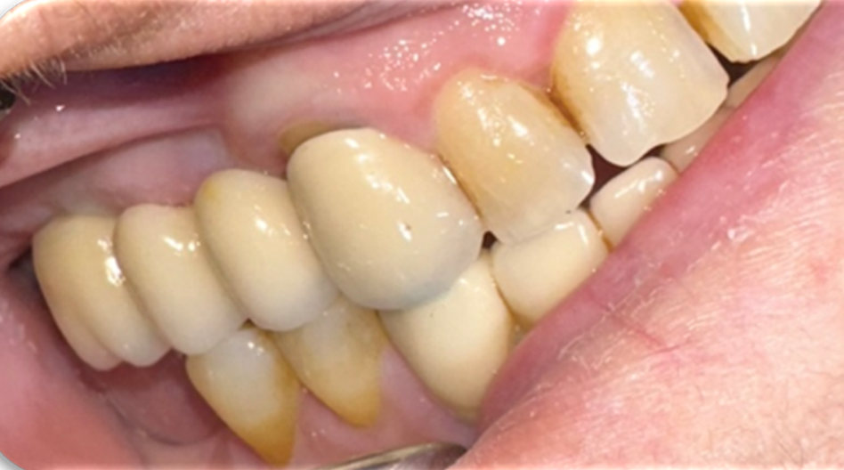 Azure - Clinical Case 3 Bridge with 2 posterior Implants (14 and 16) – Part II. Image 3