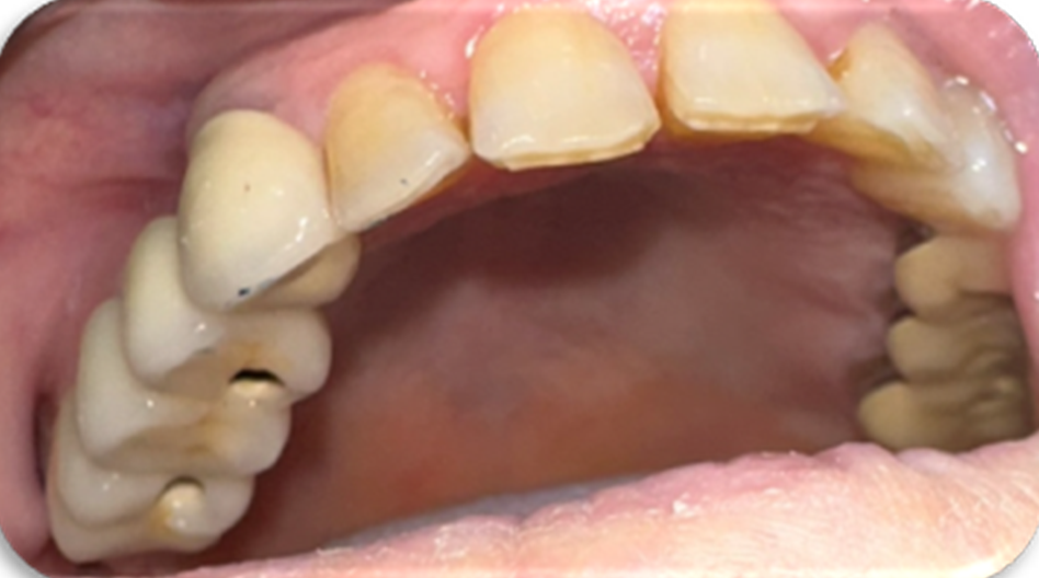 Azure - Clinical Case 3 Bridge with 2 posterior Implants (14 and 16) – Part II. Image 2
