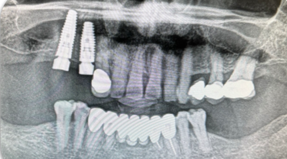 Azure - Clinical Case 3 Bridge with 2 posterior Implants (14 and 16) – Part II. Image 4