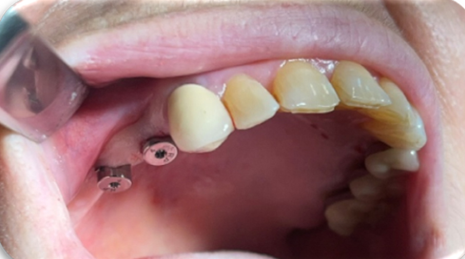 Azure - Clinical Case 3 Bridge with 2 posterior Implants (14 and 16) – Part II. Image 1