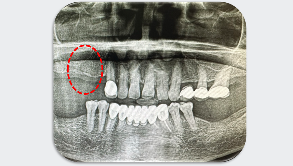 Azure Clinical Case 3 Bridge with 2 posterior Implants (14 and 16) – Part I. Image 1