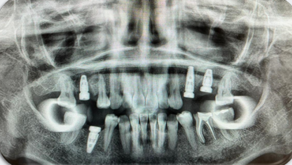 Azure Clinical Case 2: 4 single unit Implants in posterior zone: 16, 24, 26 and 45. Post Implant Placement Panoramic X-Ray