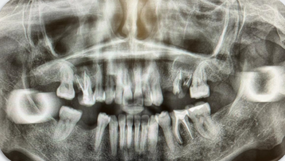 Azure Clinical Case 2: 4 single unit Implants in posterior zone: 16, 24, 26 and 45. Previous Panoramic X-Ray