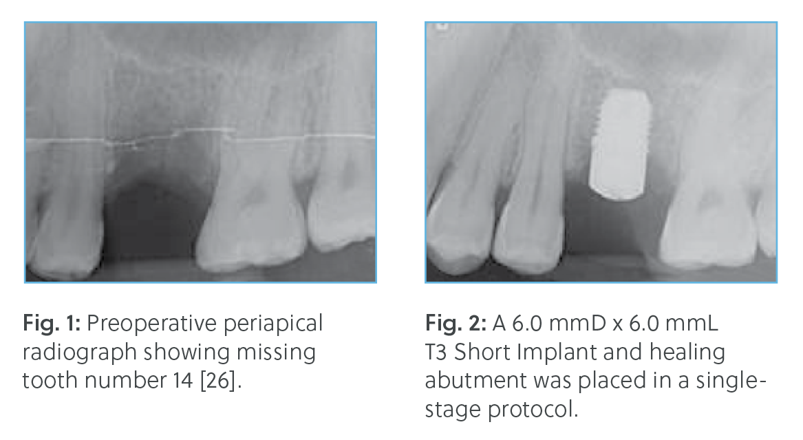 Radiographic case of a 32-year-old male with diminished bone height under the sinus after extraction of the maxillary left first molar. Preoperative X-ray shows missing tooth #14. Postoperative image demonstrates placement of a 6.0 mmD x 6.0 mmL T3 Short Implant with healing abutment in a single-stage protocol.