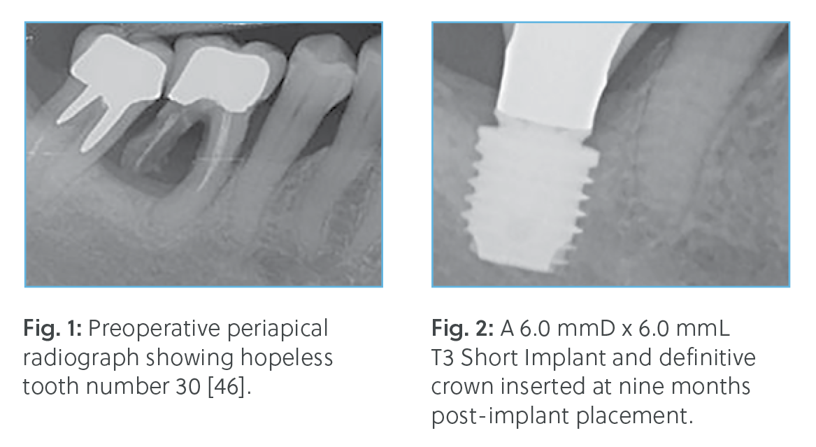 Dental case study of a 60-year-old female patient with severe bone loss due to periodontitis. Preoperative radiograph shows a hopeless first molar (tooth #30). Postoperative image displays a 6.0 mmD x 6.0 mmL T3 Short Implant with a definitive crown successfully placed nine months after surgery.