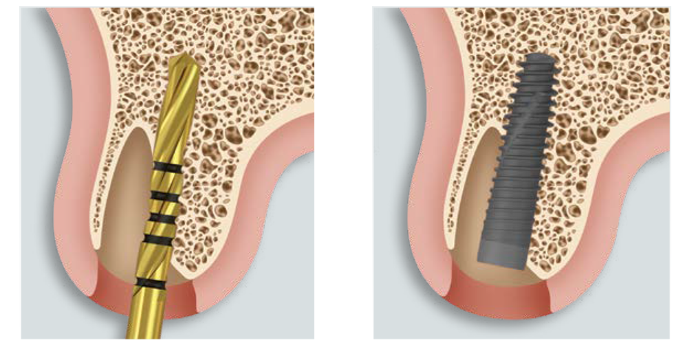 TSX Implants - Placement Predictability