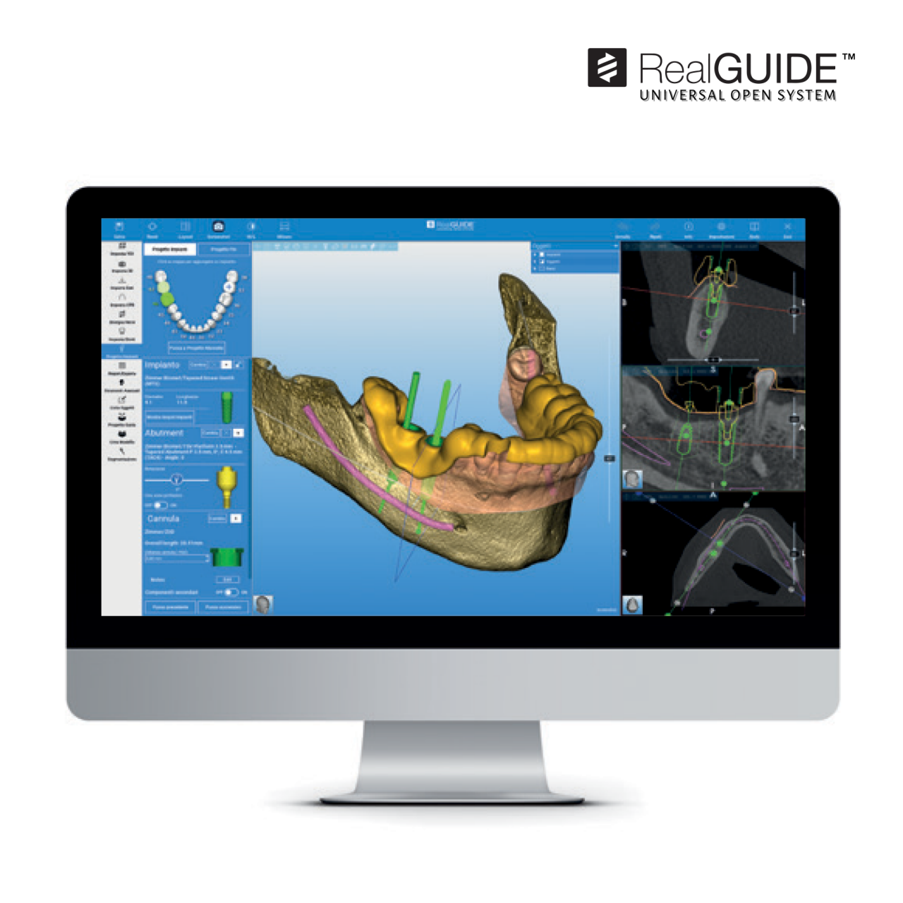 RealGUIDE Software Suite for Practice and Laboratory Computer monitor displaying 3D dental implant planning software from the RealGUIDE Software Suite, an in-house solution for both clinicians and laboratories. The system supports diagnosis, surgical guide design, and customized drilling reports to optimize dental implant therapy.