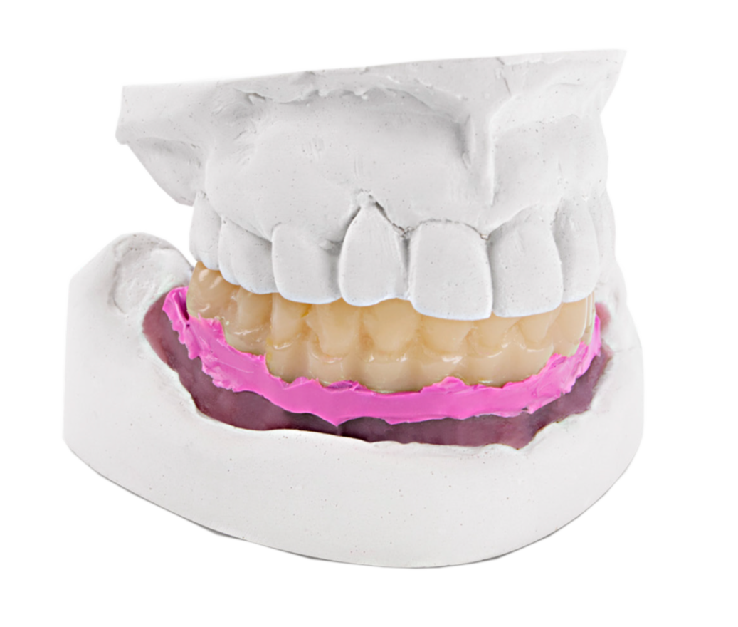 Dental model with prosthetic teeth and pink gingival mask for restorative fitting