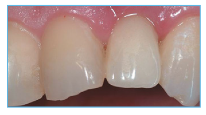 Fig. 5. The provisional restoration was  fabricated, occlusal and interproximal contacts were checked, adjusted  accordingly, and delivered to the patient. 
