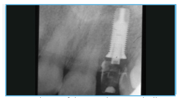 Fig. 6. A periapical radiograph was taken of the provisional restoration.